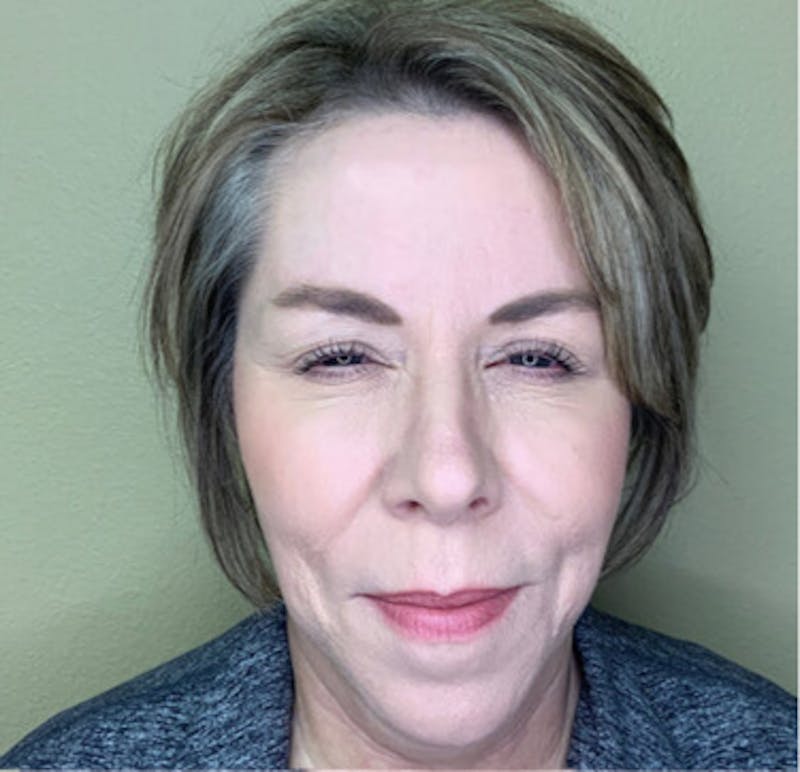 BOTOX Before & After Gallery - Patient 29408629 - Image 2