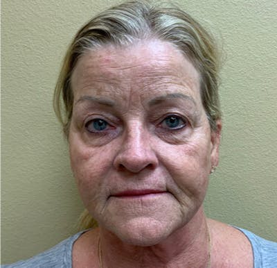 BOTOX Before & After Gallery - Patient 29408630 - Image 1