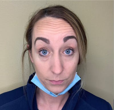 BOTOX Before & After Gallery - Patient 29408631 - Image 1