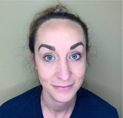 BOTOX Before & After Gallery - Patient 29408631 - Image 2