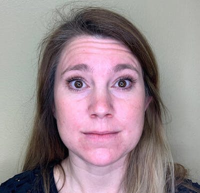 BOTOX Before & After Gallery - Patient 29408634 - Image 1