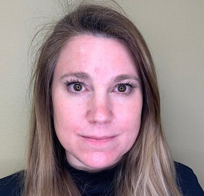 BOTOX Before & After Gallery - Patient 29408634 - Image 2