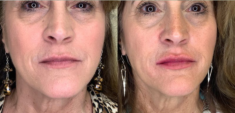 Lip Augmentation Before & After Gallery - Patient 38203947 - Image 1