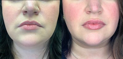Lip Augmentation Before & After Gallery - Patient 38203948 - Image 1