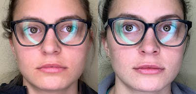Lip Augmentation Before & After Gallery - Patient 38203949 - Image 1