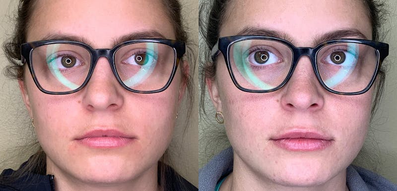 Lip Augmentation Before & After Gallery - Patient 38203949 - Image 1