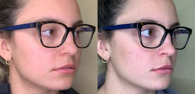 Lip Augmentation Before & After Gallery - Patient 38203949 - Image 2