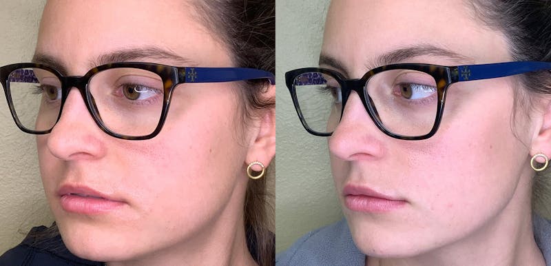 Lip Augmentation Before & After Gallery - Patient 38203949 - Image 3