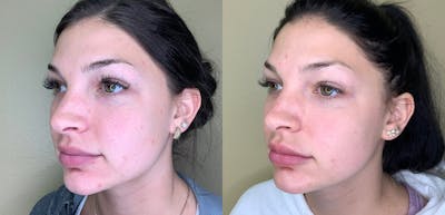 Lip Augmentation Before & After Gallery - Patient 38203950 - Image 1
