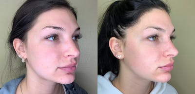 Lip Augmentation Before & After Gallery - Patient 38203950 - Image 2