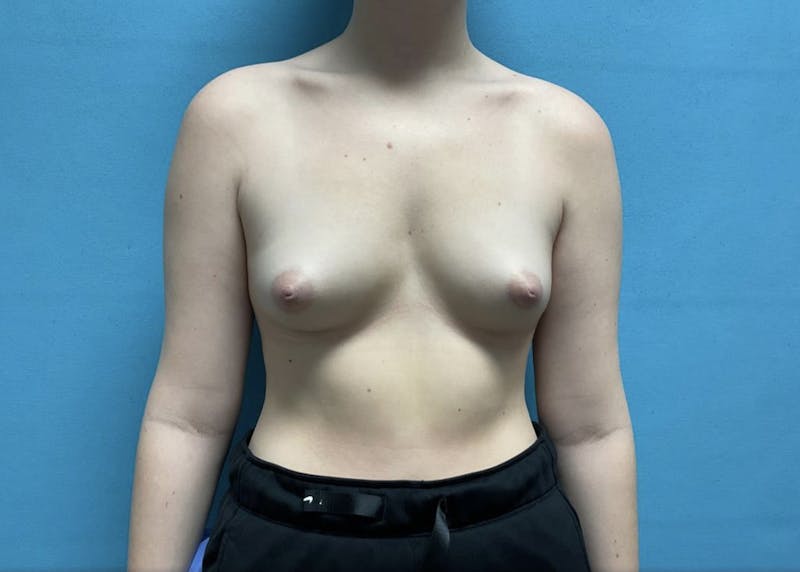 Breast Augmentation Before & After Gallery - Patient 44940812 - Image 1