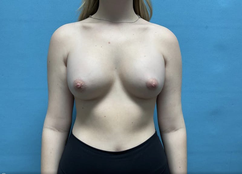 Breast Augmentation Before & After Gallery - Patient 44940812 - Image 2