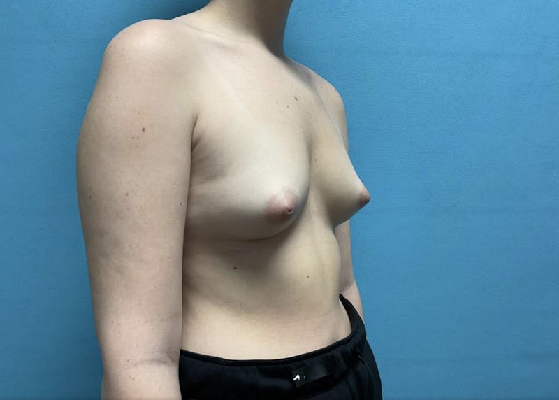 Breast Augmentation Before & After Gallery - Patient 44940812 - Image 3