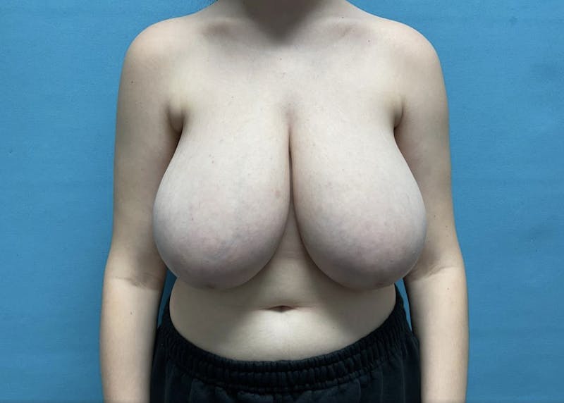 Breast Reduction Before & After Gallery - Patient 44940816 - Image 1