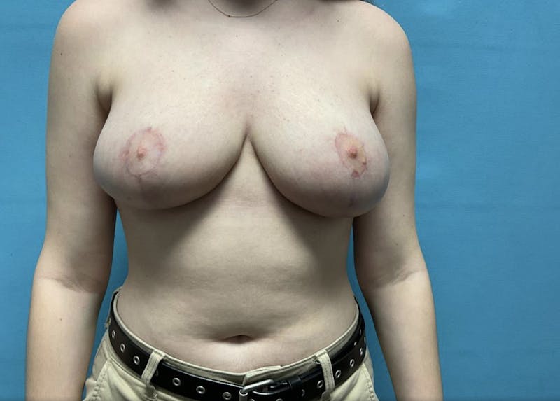Breast Reduction Before & After Gallery - Patient 44940816 - Image 2