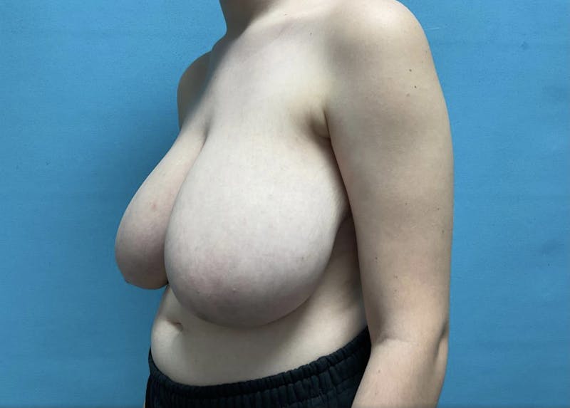 Breast Reduction Before & After Gallery - Patient 44940816 - Image 3