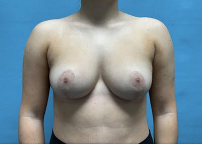 Breast Reduction Before & After Gallery - Patient 44940815 - Image 2