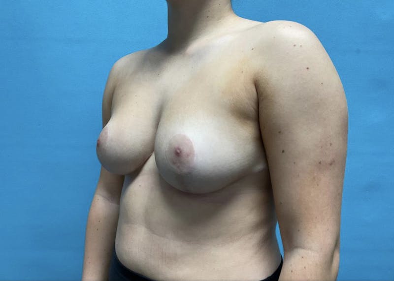 Breast Reduction Before & After Gallery - Patient 44940815 - Image 4