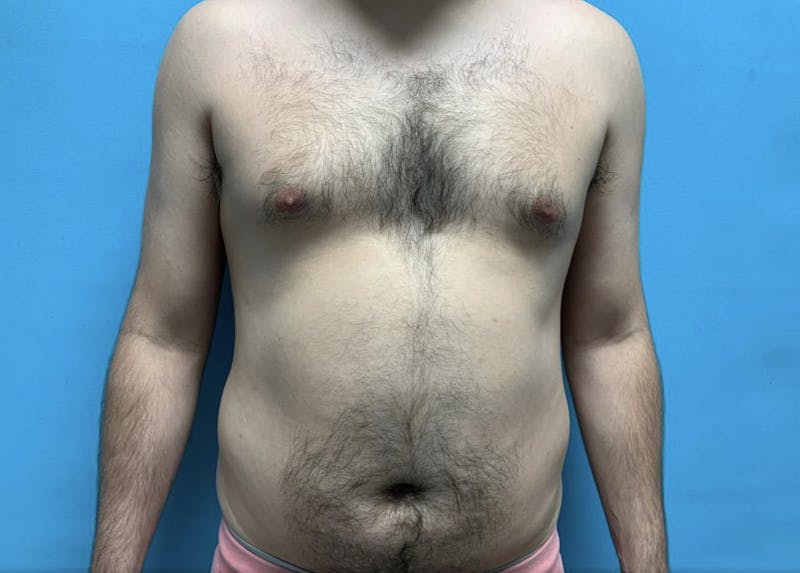 Liposuction Before & After Gallery - Patient 44940833 - Image 1