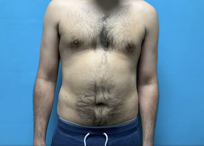 Liposuction Before & After Gallery - Patient 44940833 - Image 2