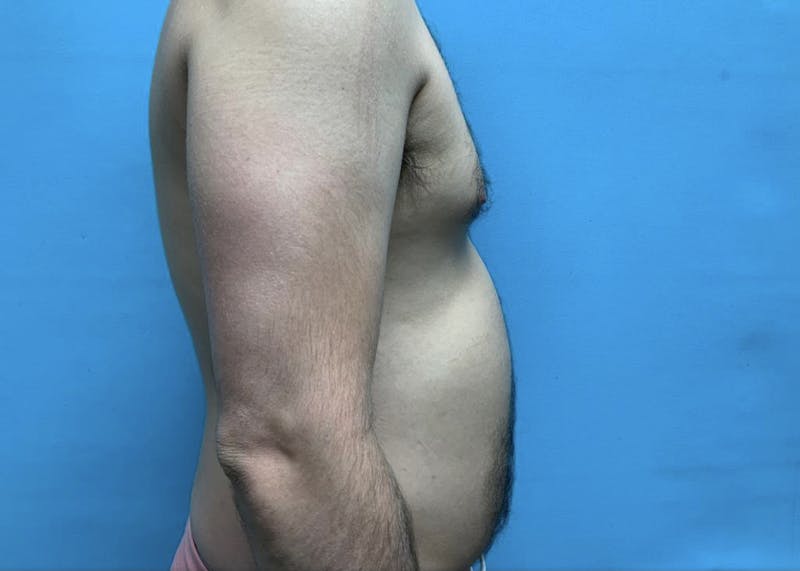Liposuction Before & After Gallery - Patient 44940833 - Image 3