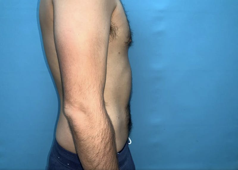 Liposuction Before & After Gallery - Patient 44940833 - Image 4