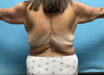 Liposuction Before & After Gallery - Patient 44940832 - Image 2