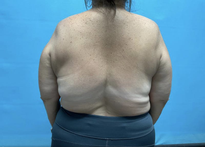 Liposuction Before & After Gallery - Patient 44940832 - Image 3