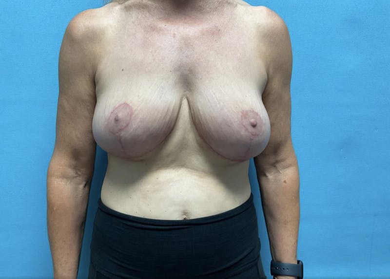 Mastopexy Before & After Gallery - Patient 44940853 - Image 2