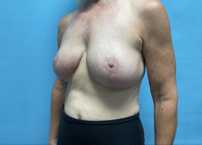Mastopexy Before & After Gallery - Patient 44940853 - Image 4