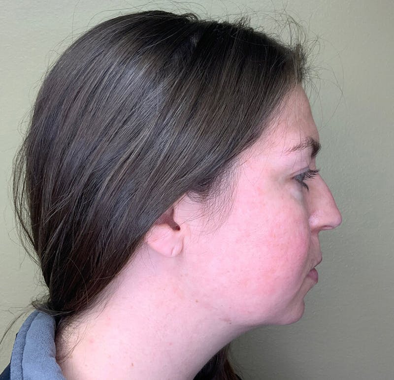 Filler Treatments Before & After Gallery - Patient 38203967 - Image 1