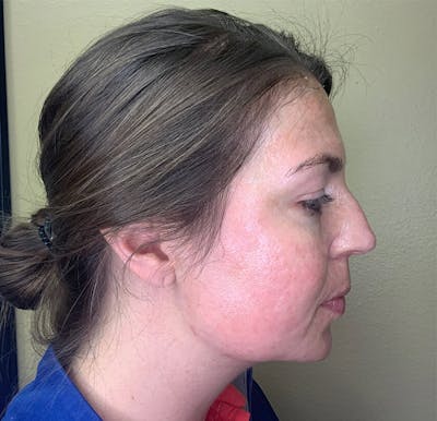 Filler Treatments Before & After Gallery - Patient 38203967 - Image 2