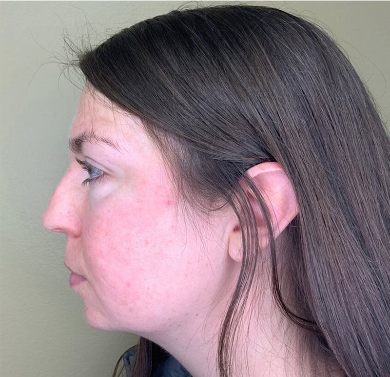 Filler Treatments Before & After Gallery - Patient 38203967 - Image 3
