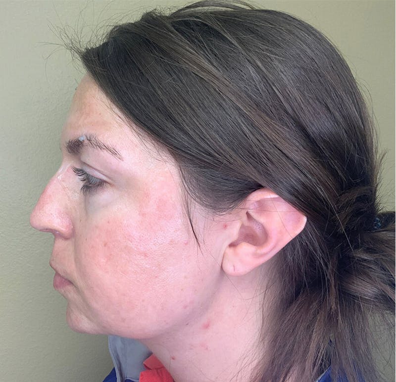Filler Treatments Before & After Gallery - Patient 38203967 - Image 4