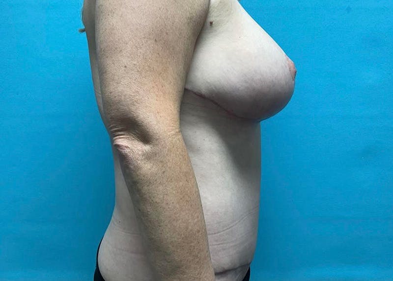 Abdominoplasty Before & After Gallery - Patient 64017289 - Image 4