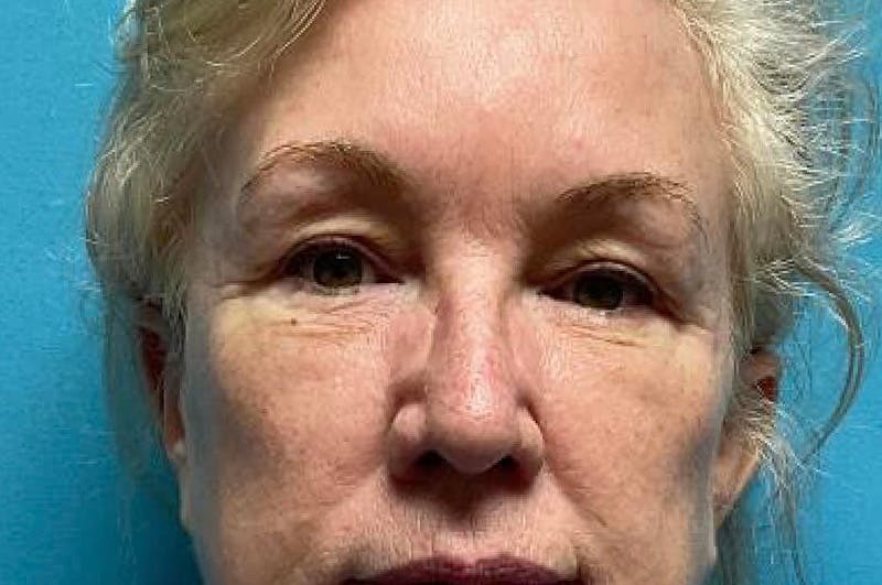 Eyelid Surgery Before & After Gallery - Patient 64017295 - Image 1