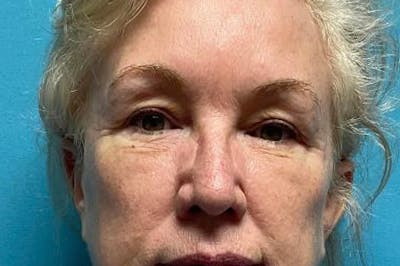 Eyelid Surgery Before & After Gallery - Patient 64017295 - Image 1