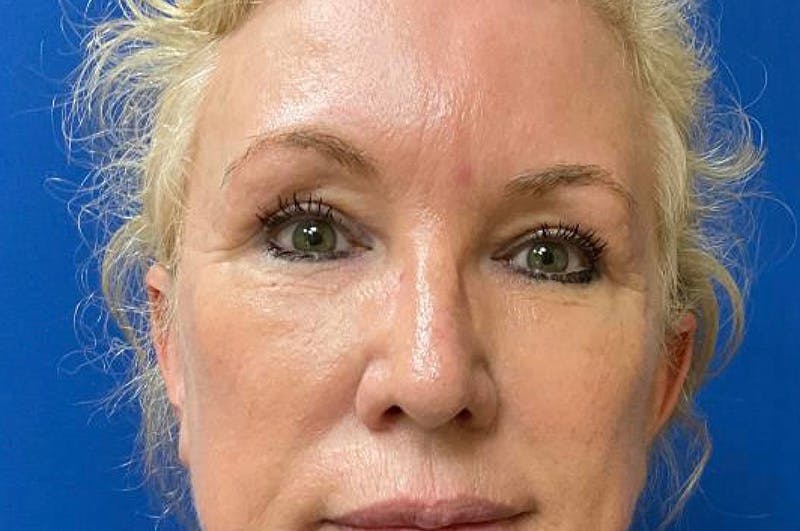 Eyelid Surgery Before & After Gallery - Patient 64017295 - Image 2