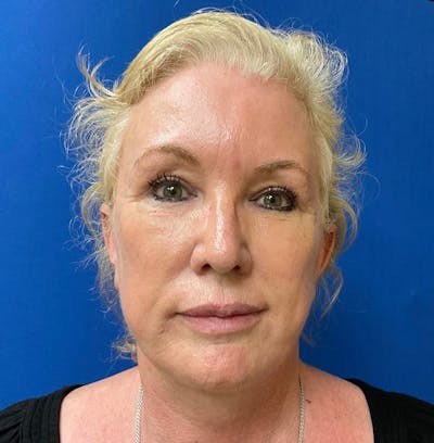 Facelift Before & After Gallery - Patient 64017296 - Image 2
