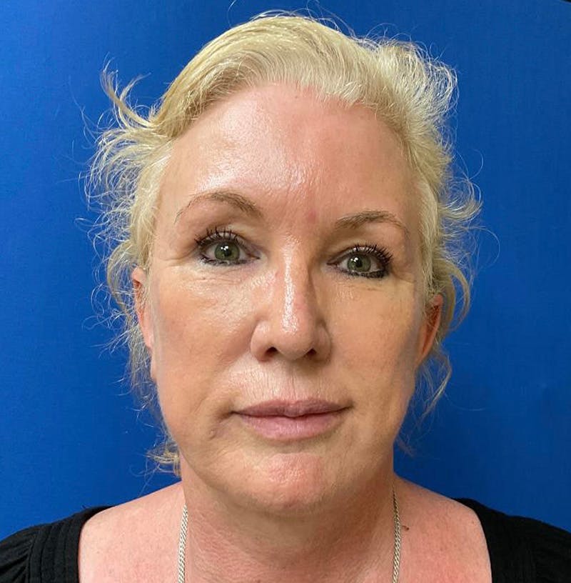 Facelift Before & After Gallery - Patient 64017296 - Image 2