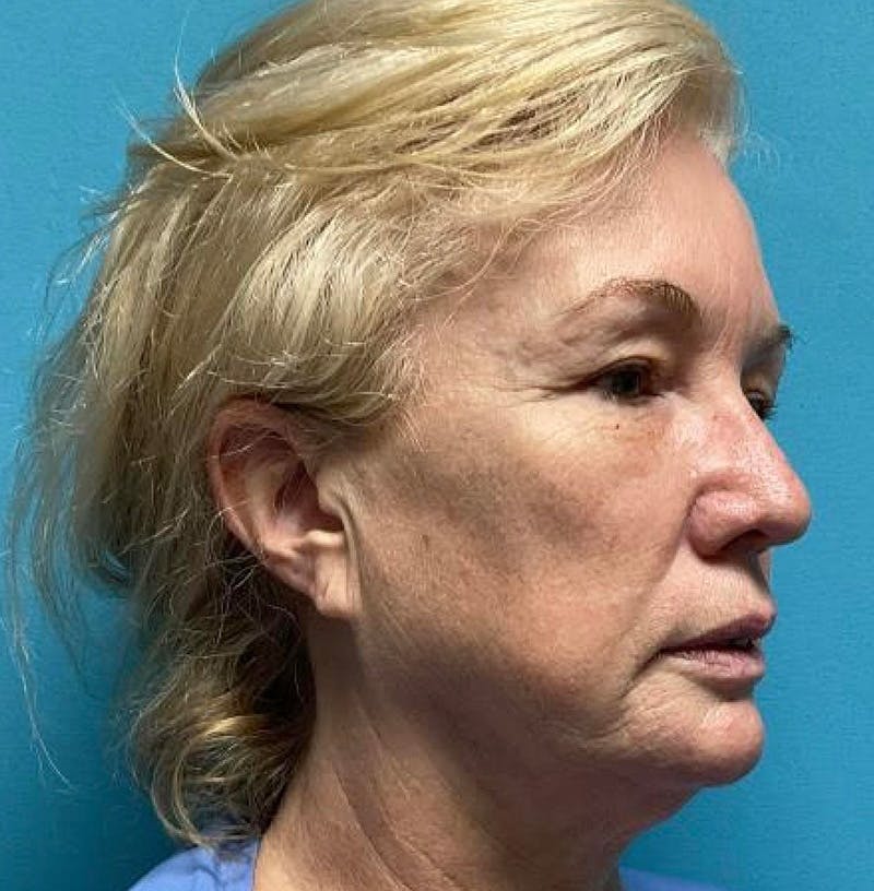 Facelift Before & After Gallery - Patient 64017296 - Image 3