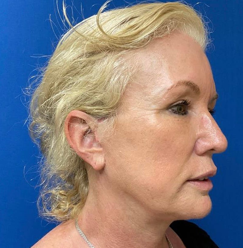 Facelift Before & After Gallery - Patient 64017296 - Image 4
