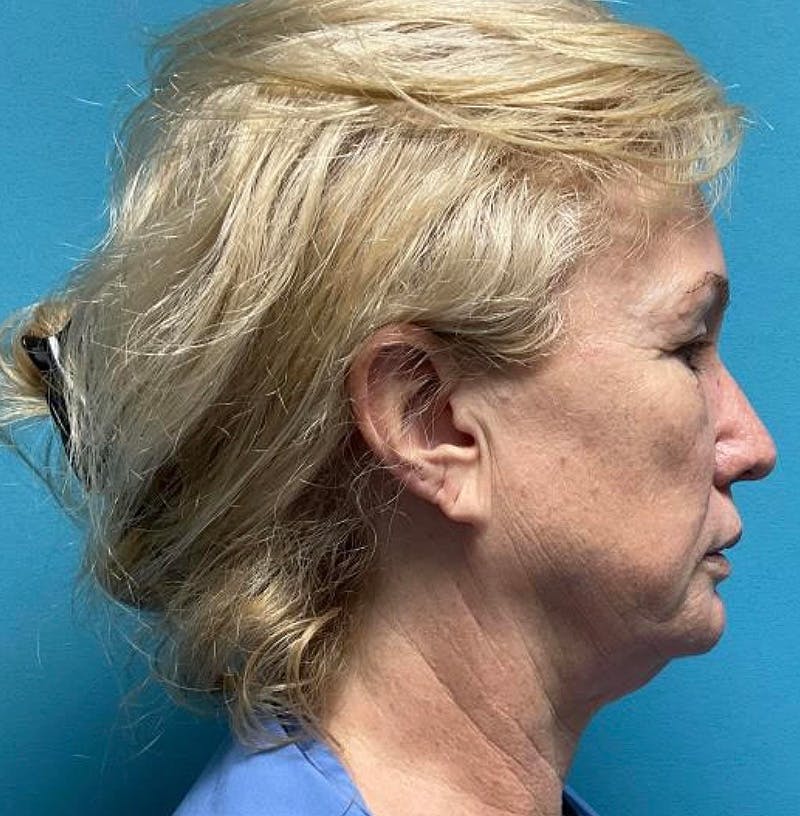 Facelift Before & After Gallery - Patient 64017296 - Image 5