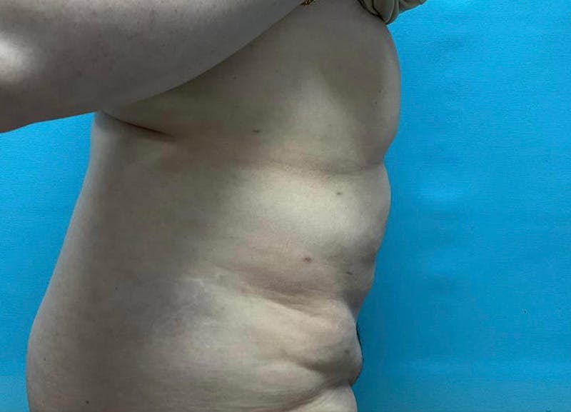 Liposuction Before & After Gallery - Patient 64017309 - Image 4