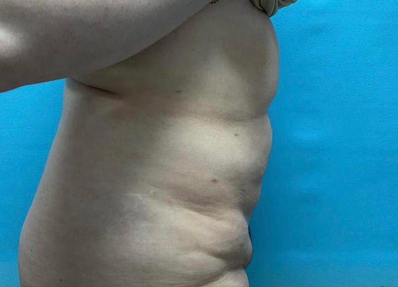Liposuction Before & After Gallery - Patient 64017309 - Image 4
