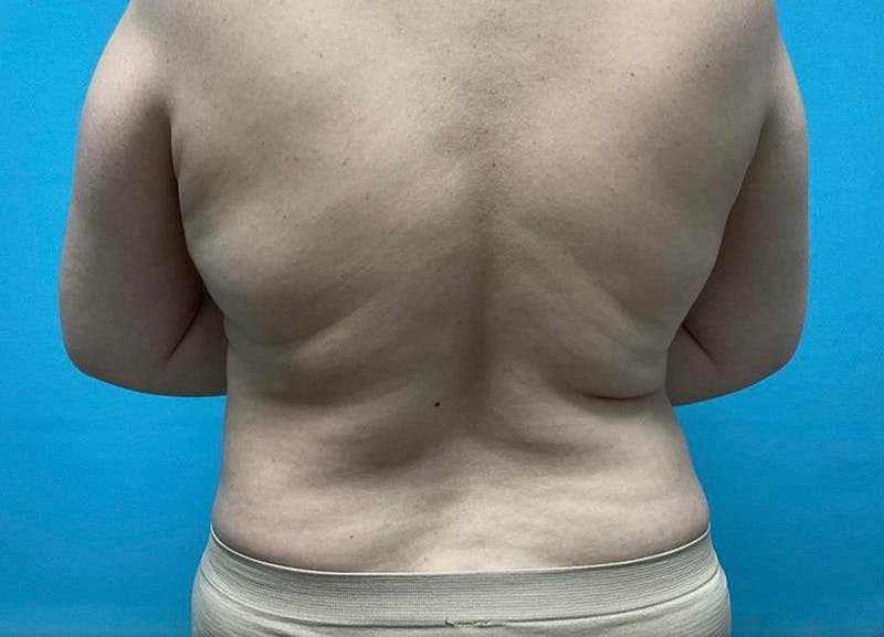 Liposuction Before & After Gallery - Patient 64017309 - Image 6