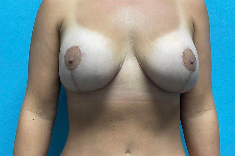 Mastopexy Before & After Gallery - Patient 64017333 - Image 2