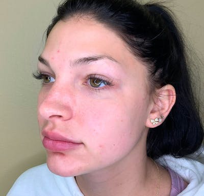 Lip Augmentation Before & After Gallery - Patient 38203950 - Image 2