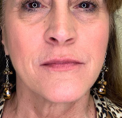 Lip Augmentation Before & After Gallery - Patient 38203947 - Image 1