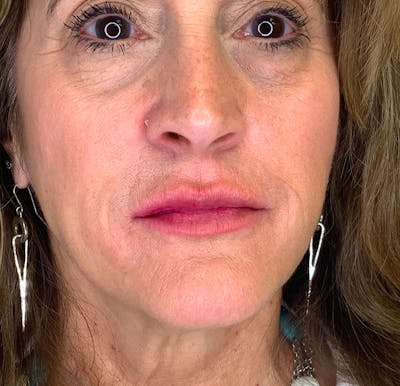 Lip Augmentation Before & After Gallery - Patient 38203947 - Image 2